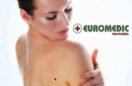 Samo 770 din za pregled svih mladeža na telu dermatoskopijom u poliklinici Euromedik!